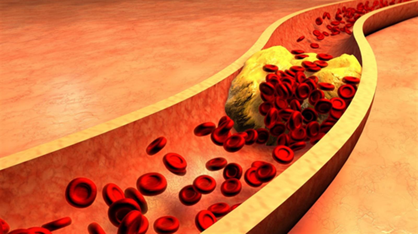 高膽固醇會嚴重損害你的心臟   10個控制膽固醇的簡單方法