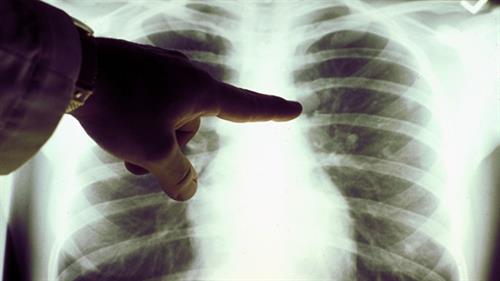 肺癌初期絕對不能忽視的原因和症狀