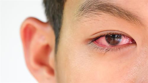 你不可不知的15種導致眼睛發紅或充血的常見原因