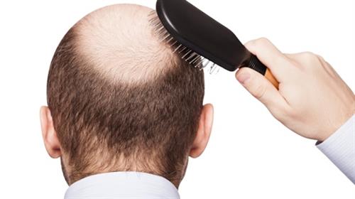 有脫髮問題? 補充這些維生素有助促進頭髮生長