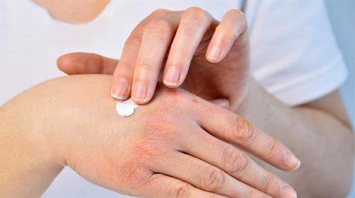 冬季皮膚乾燥如何改善? 皮膚科專家教你告別皮膚乾燥的5種方法